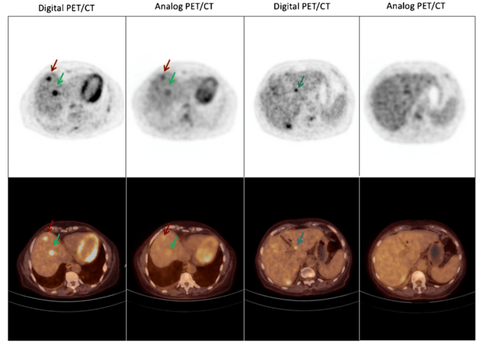 How Do Digital PET/CT Scans In Malaysia Offer Better Imaging Results